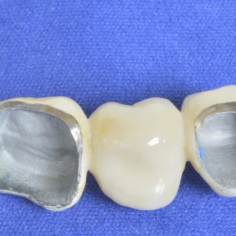 teeth with metal and porcelain